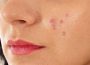 How to Get Rid of Pimples Permanently and Naturally